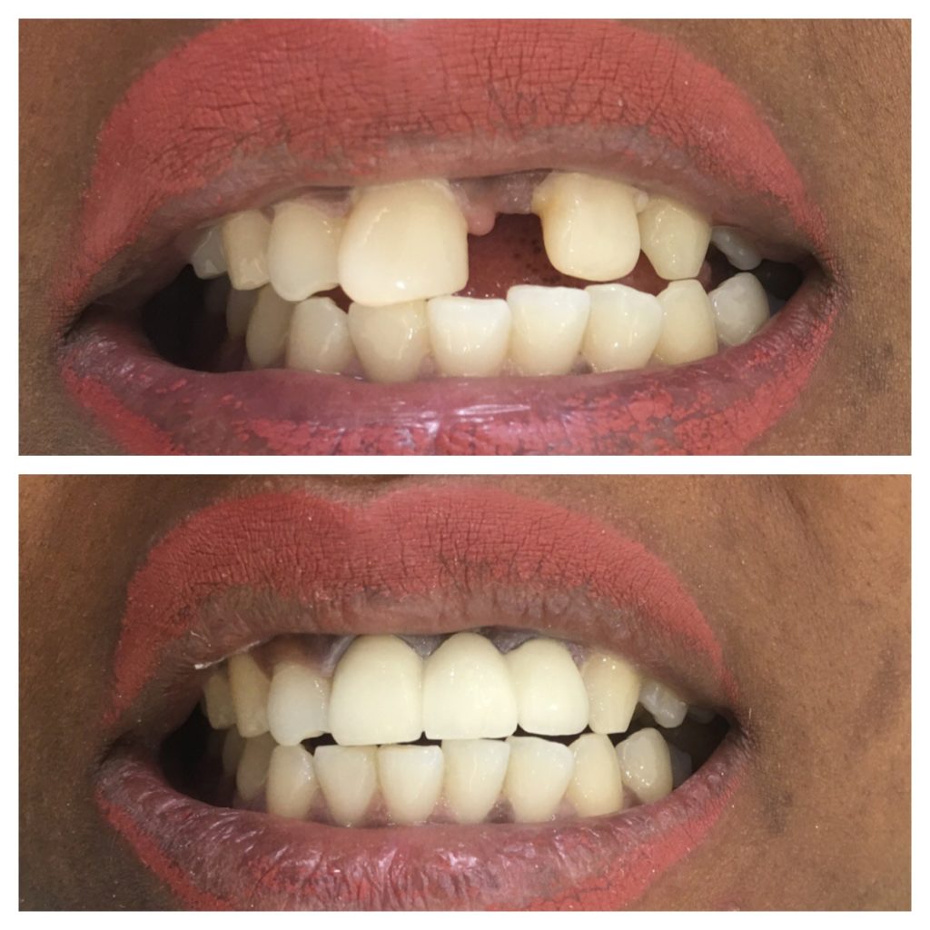 Before and after of a missing tooth replaced with a dental implant crown at Dr. Saket's Dental Makeover, Indirapuram