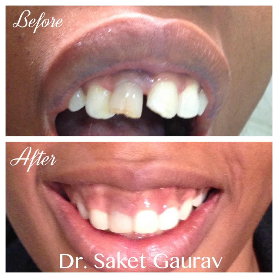 Dentist performing a painless rotary root canal procedure at Dr. Saket's Dental Makeover, Indirapuram Ghaziabad
