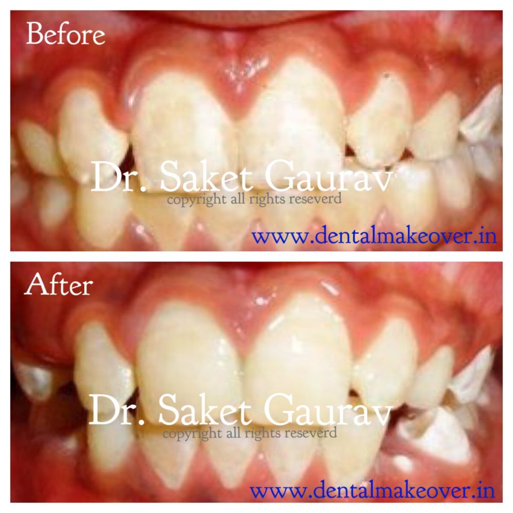 Clear aligner tray being fitted for teeth straightening at Dr. Saket's Dental Makeover, Indirapuram