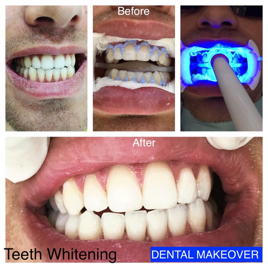 In-clinic professional teeth whitening session with gum protection in place at Dr. Saket's Dental Makeover, Indirapuram
