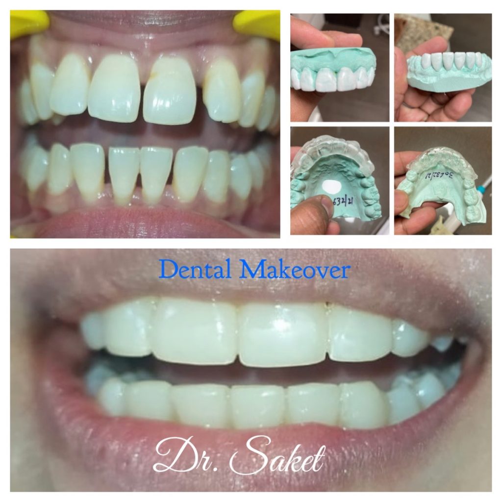 Porcelain dental veneers being bonded to the upper front teeth at Dr. Saket's Dental Makeover, Indirapuram